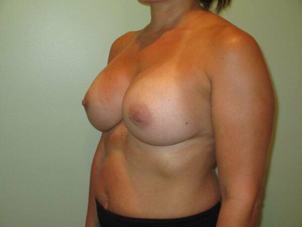 Breast Augmentation Before & After