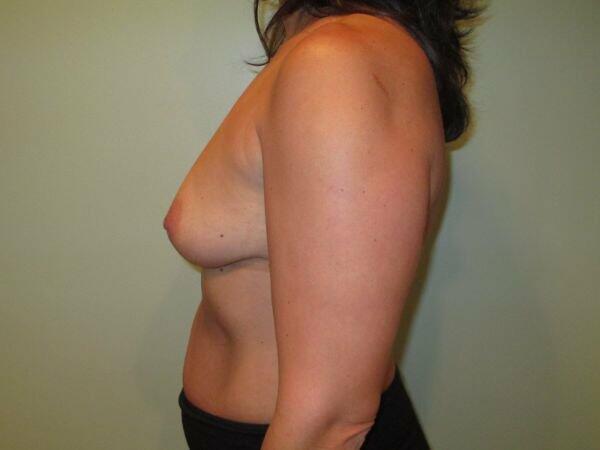 Breast Augmentation Before & After