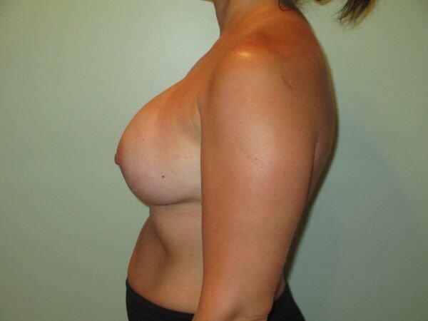 Breast Augmentation Before & After