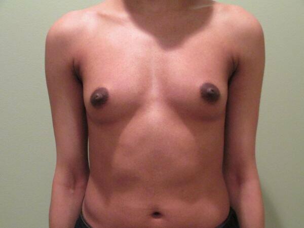 Breast Augmentation Before & After