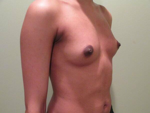 Breast Augmentation Before & After