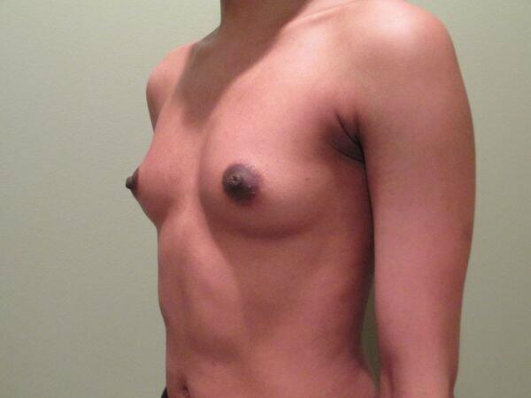 Breast Augmentation Before & After