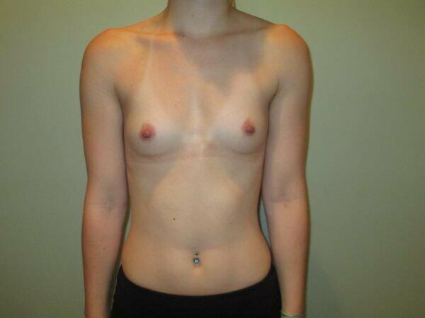 Breast Augmentation Before & After