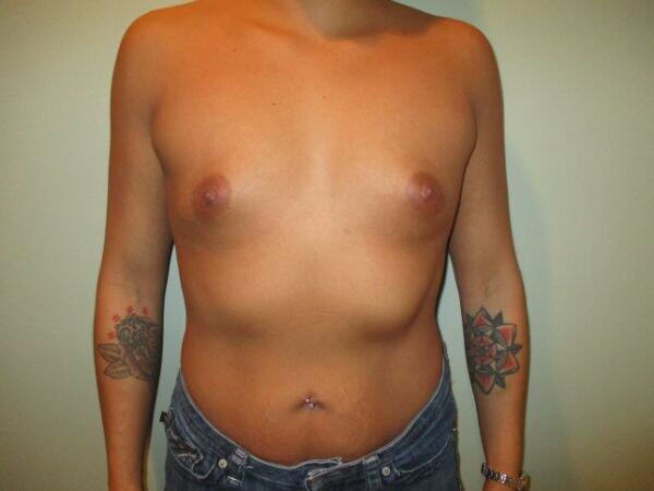 Breast Augmentation Before & After