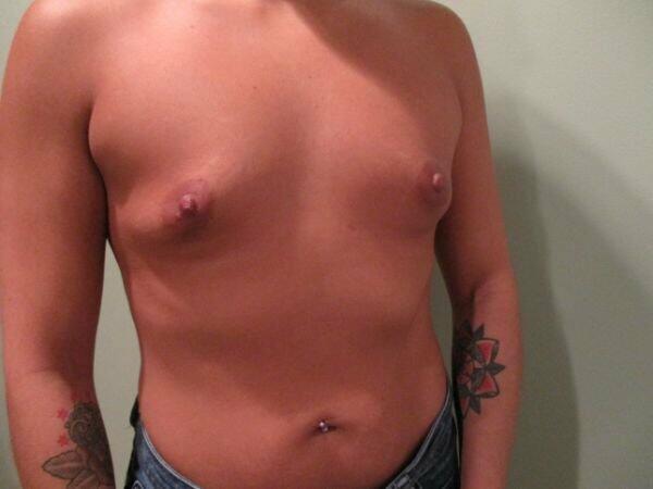 Breast Augmentation Before & After