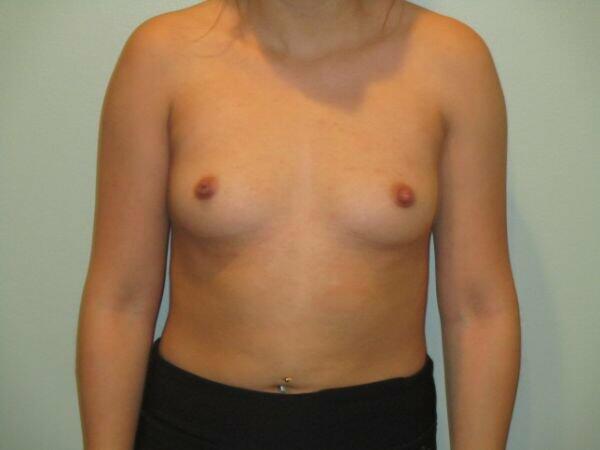 Breast Augmentation Before & After