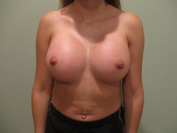 Breast Augmentation Before & After