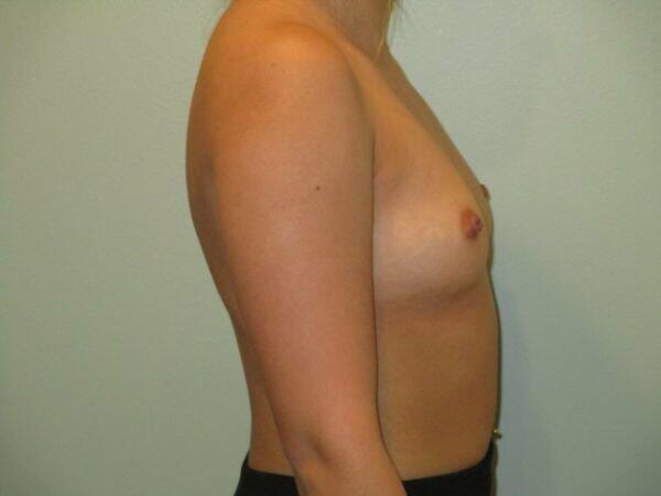 Breast Augmentation Before & After