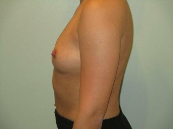 Breast Augmentation Before & After