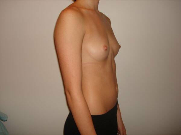 Breast Augmentation Before & After