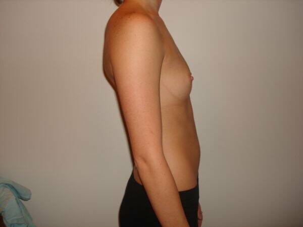 Breast Augmentation Before & After