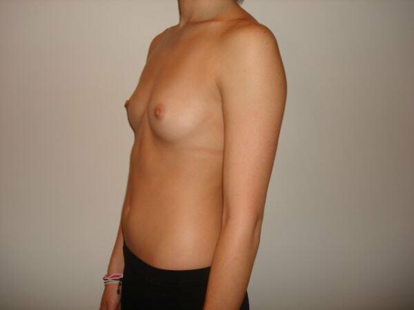 Breast Augmentation Before & After