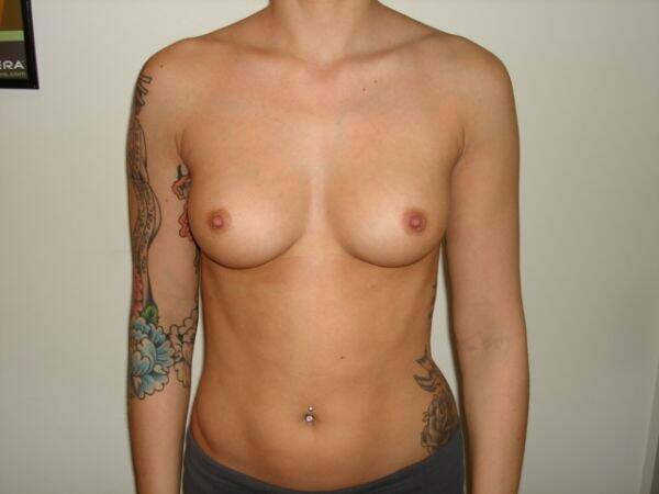 Breast Augmentation Before & After