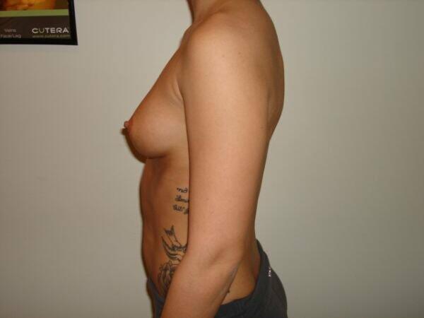 Breast Augmentation Before & After