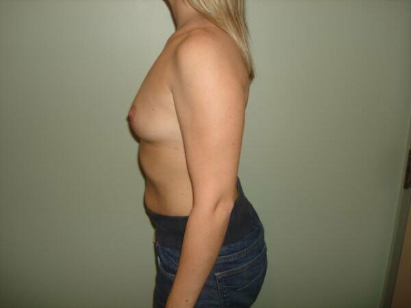 Breast Augmentation Before & After