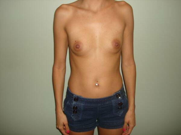 Breast Augmentation Before & After