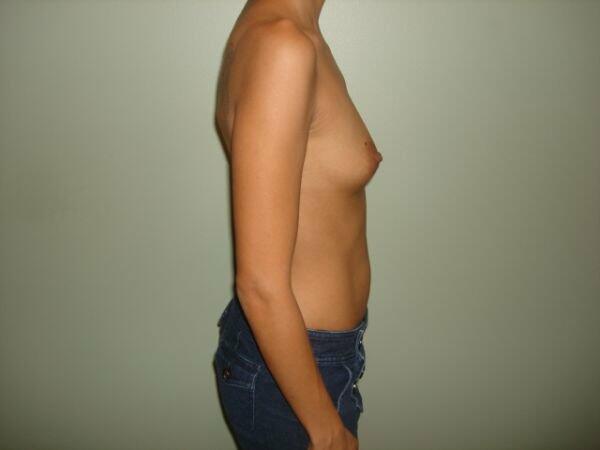 Breast Augmentation Before & After