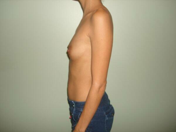 Breast Augmentation Before & After