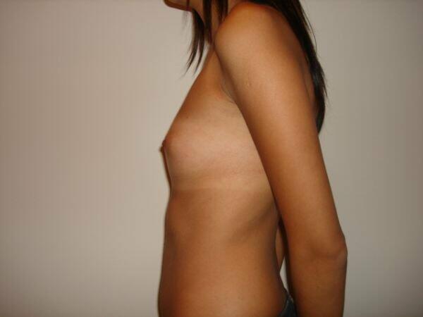 Breast Augmentation Before & After