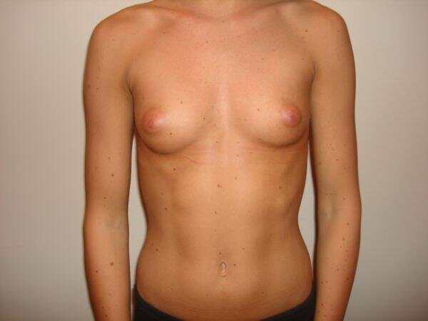 Breast Augmentation Before & After