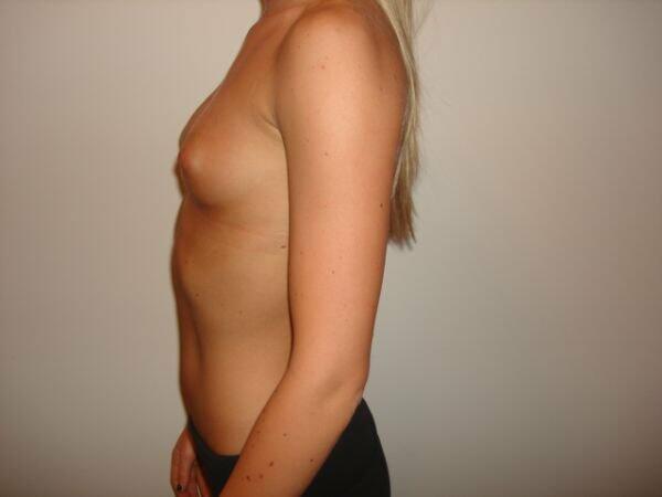 Breast Augmentation Before & After