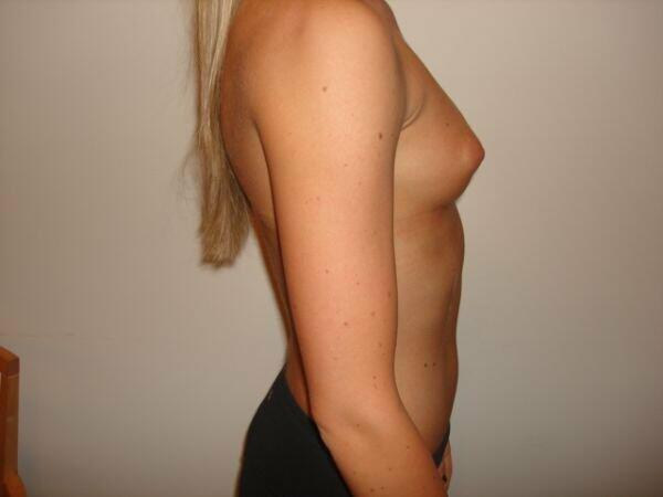 Breast Augmentation Before & After