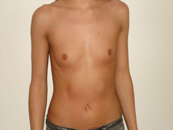 Breast Augmentation Before & After