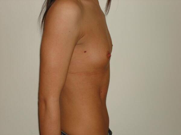 Breast Augmentation Before & After