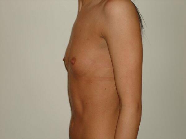 Breast Augmentation Before & After