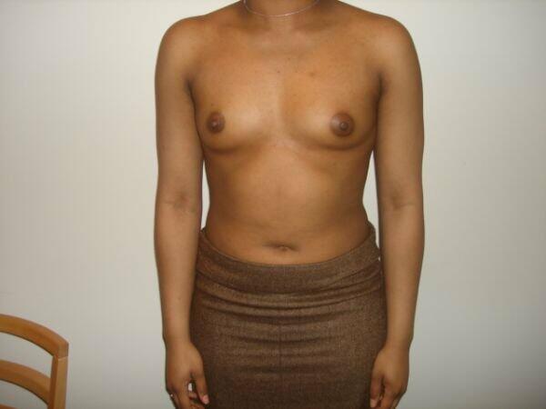 Breast Augmentation Before & After