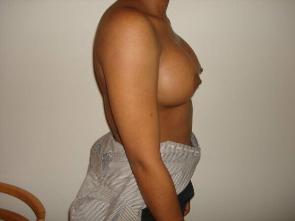 Breast Augmentation Before & After