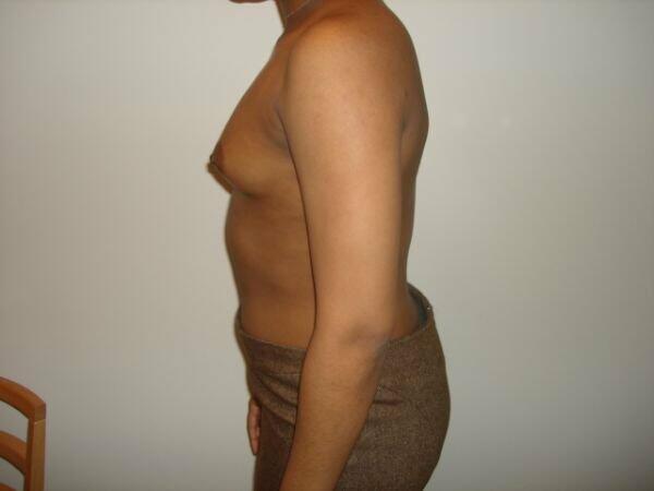 Breast Augmentation Before & After