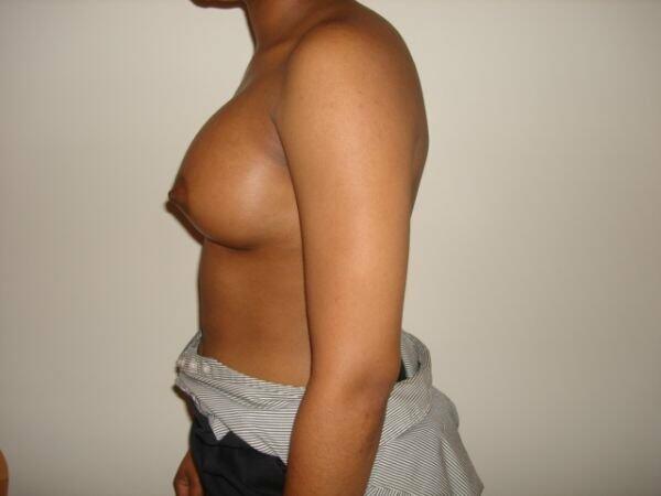 Breast Augmentation Before & After