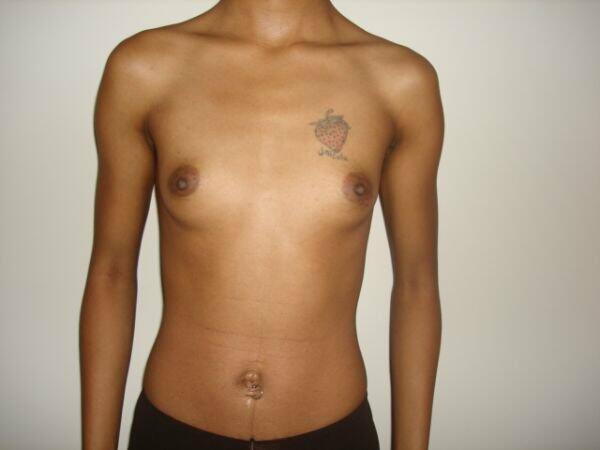 Breast Augmentation Before & After