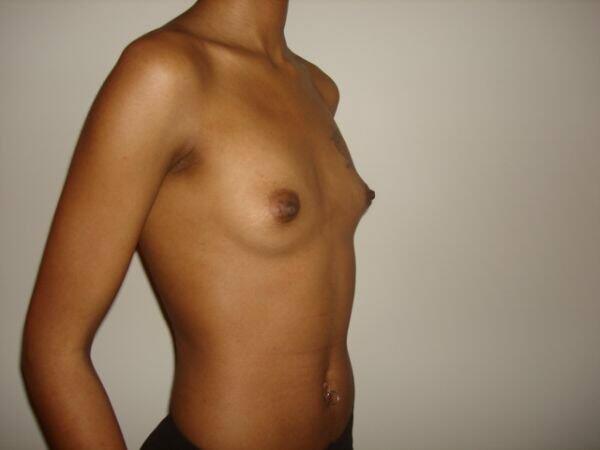 Breast Augmentation Before & After