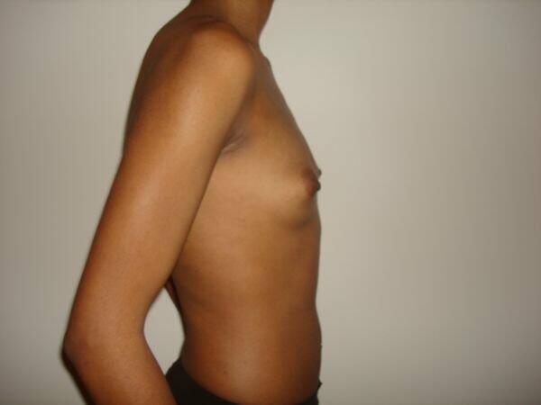 Breast Augmentation Before & After