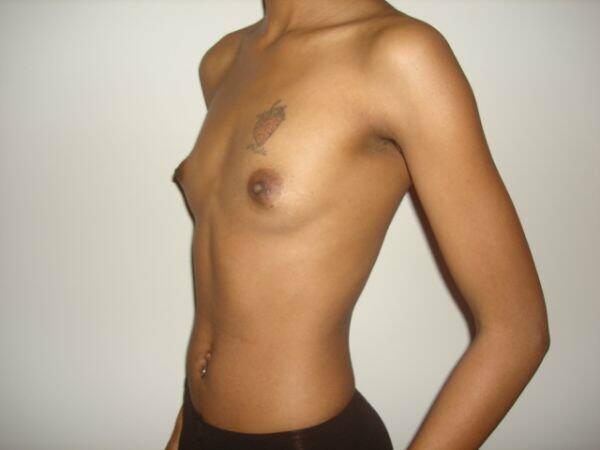 Breast Augmentation Before & After