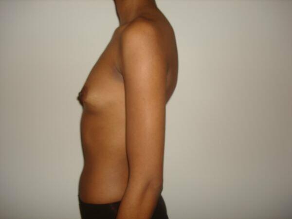 Breast Augmentation Before & After