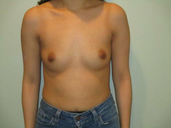 Breast Augmentation Before & After