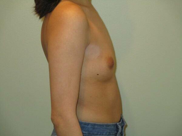 Breast Augmentation Before & After