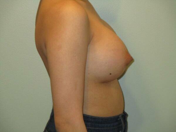 Breast Augmentation Before & After