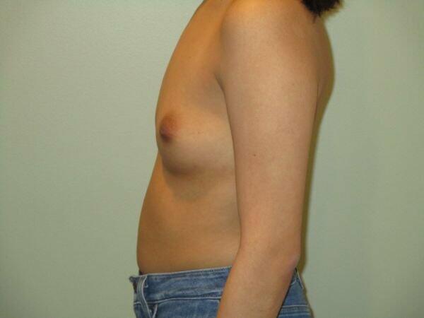 Breast Augmentation Before & After