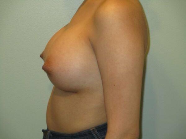 Breast Augmentation Before & After