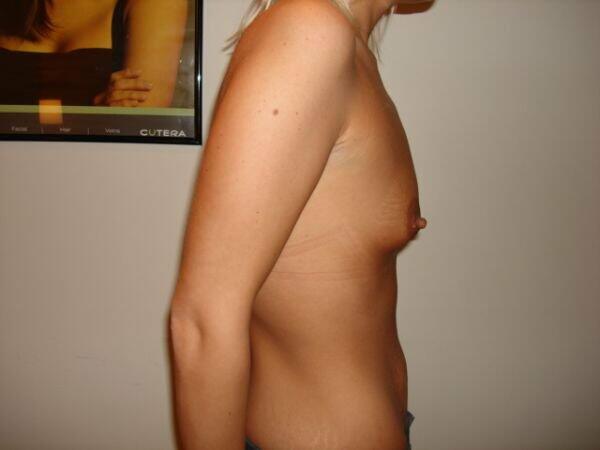 Breast Augmentation Before & After