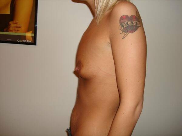 Breast Augmentation Before & After