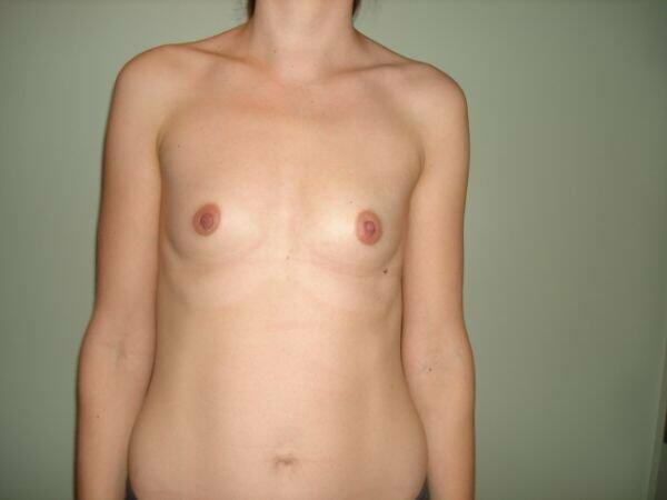 Breast Augmentation Before & After