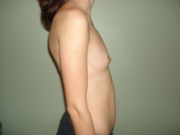 Breast Augmentation Before & After