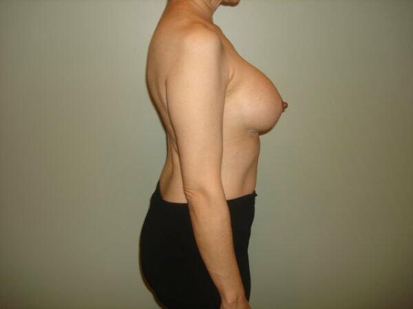 Breast Augmentation Before & After