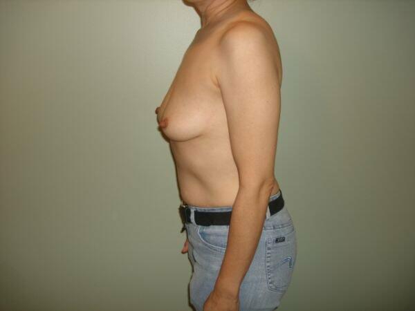 Breast Augmentation Before & After