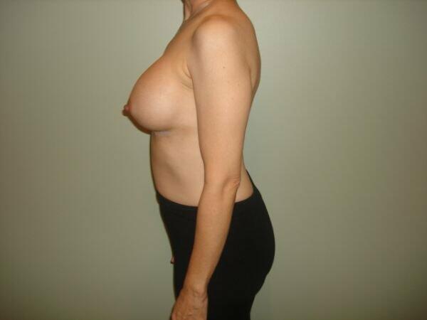 Breast Augmentation Before & After